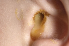 EARDISCHARGE