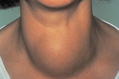 GOITRETREATMENT