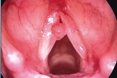 MICROLARYNGEALSURGERY