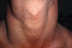NECKSWELLING