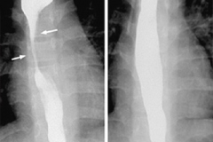 OBSTRUCTIONINNECK
