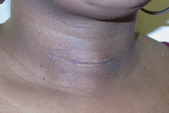 PARATHYROIDSURGER-MINI-INCISION