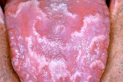 TONGUEDISEASES