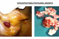 Cholesteatoma postaural growth
