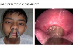 Nasopharyngeal stenosis treatment