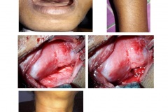 Parathyroid Tumor