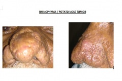Rhinophyma / Potato nose tumor