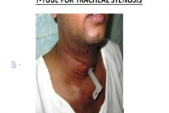T-Tube for tracheal stenosis