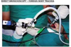 Direct Bronchoscopy - Foreign body trachea