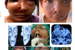 Bilateral giant cell reparative granuloma