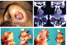 Nasal polyp