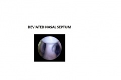 DEVIATED-NASAL-SEPTUM