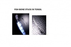 FISH-BONE-STUCK-IN-TONSIL