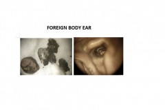 FOREIGN-BODY-EAR