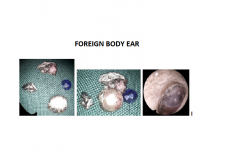 FOREIGN-BODY-EAR_1