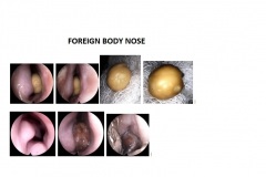 FOREIGN-BODY-NOSE