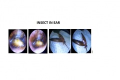 INSECT-IN-EAR