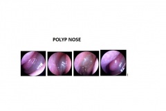 POLYP-NOSE