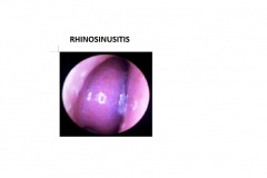 RHINOSINUSITIS