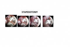 STAPEDOTOMY