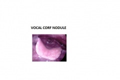 VOCAL-CORF-NODULE